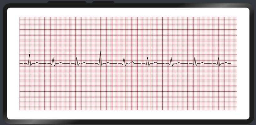 #打卡不停更# HarmonyOS - 基于ArkUI(ETS) 实现心电图组件-鸿蒙开发者社区